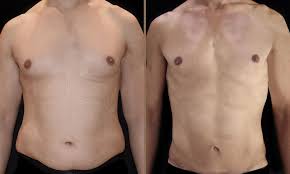 Gynecomastia in Dubai